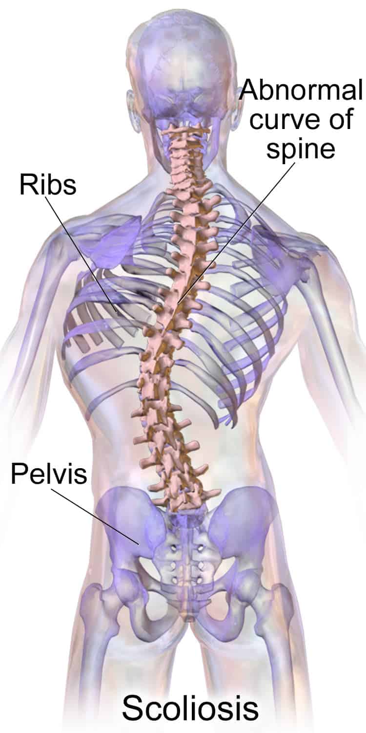 Yoga for Scoliosis - What is it?