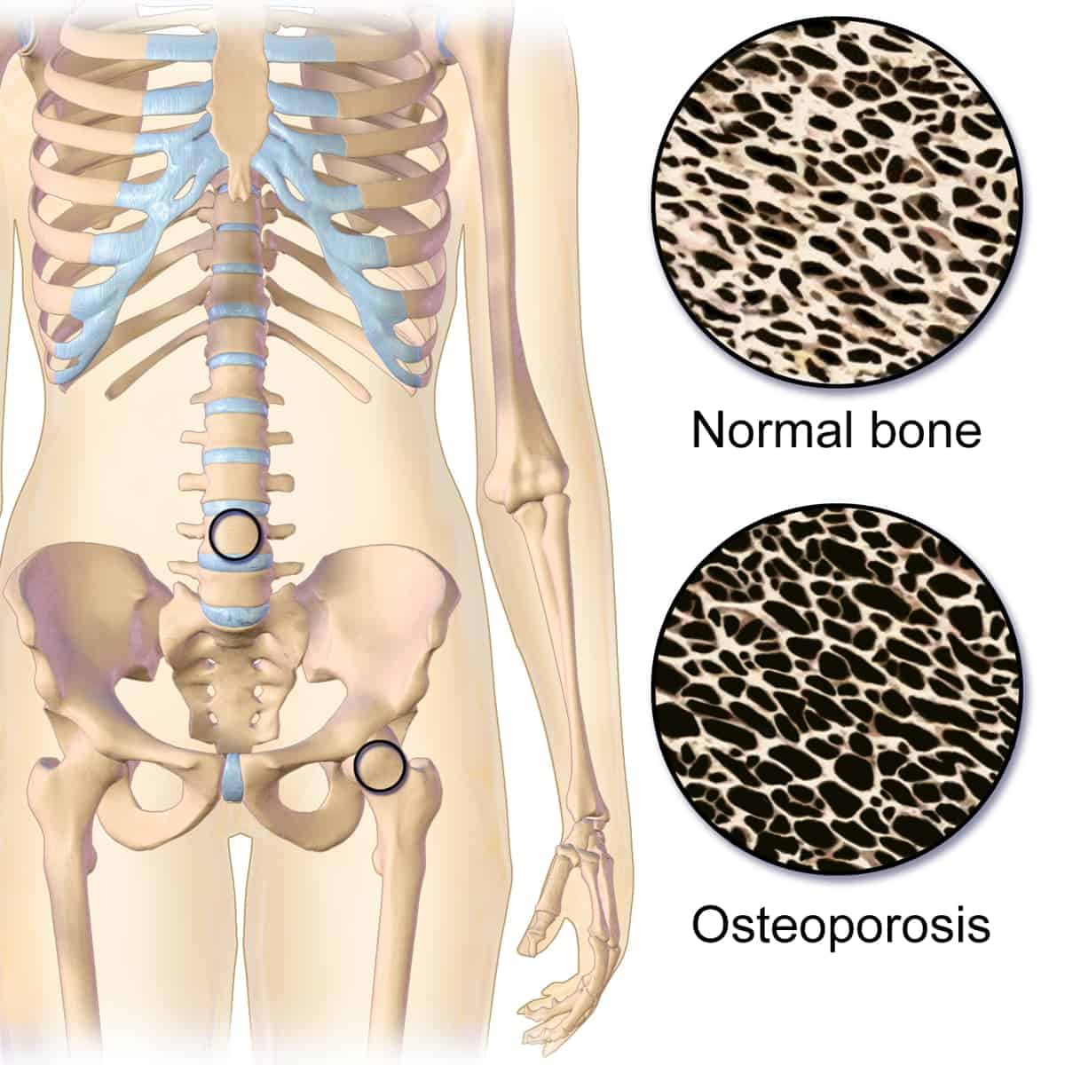 Yoga for Osteoporosis - What is it?